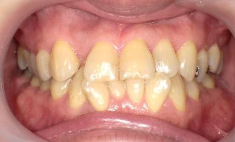 部分矯正 40代の症例写真