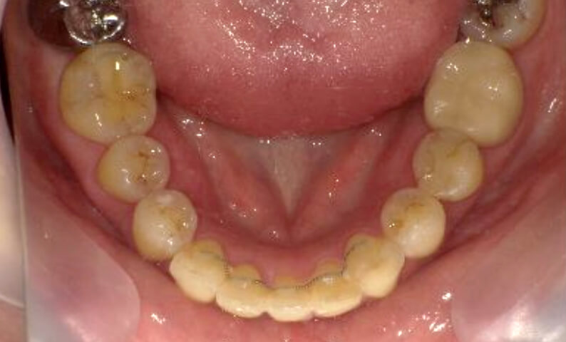 部分矯正 40代の症例写真