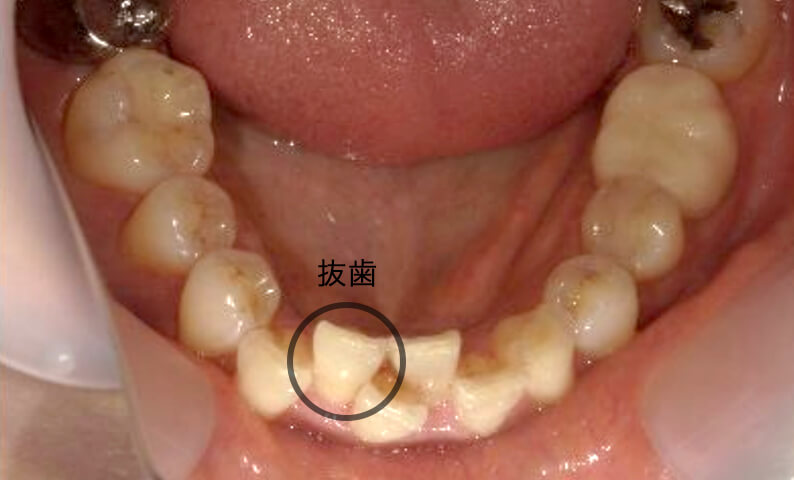 部分矯正 40代の症例写真
