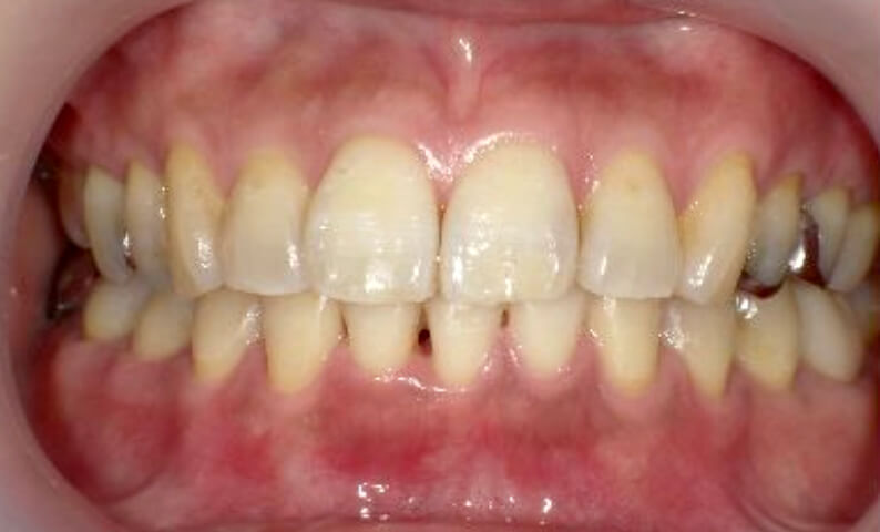 部分矯正 40代の症例写真