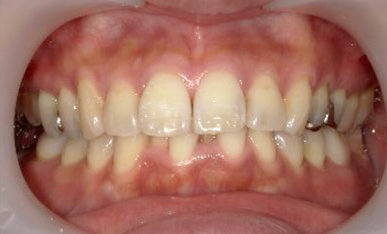 部分矯正 40代の症例写真