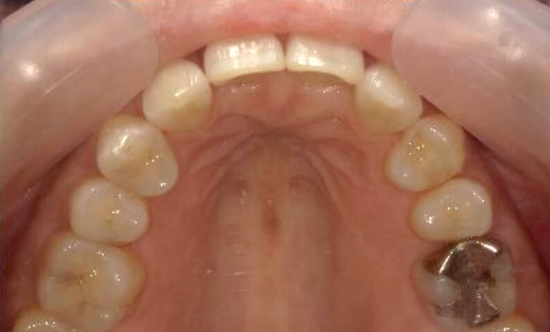 部分矯正 40代の症例写真