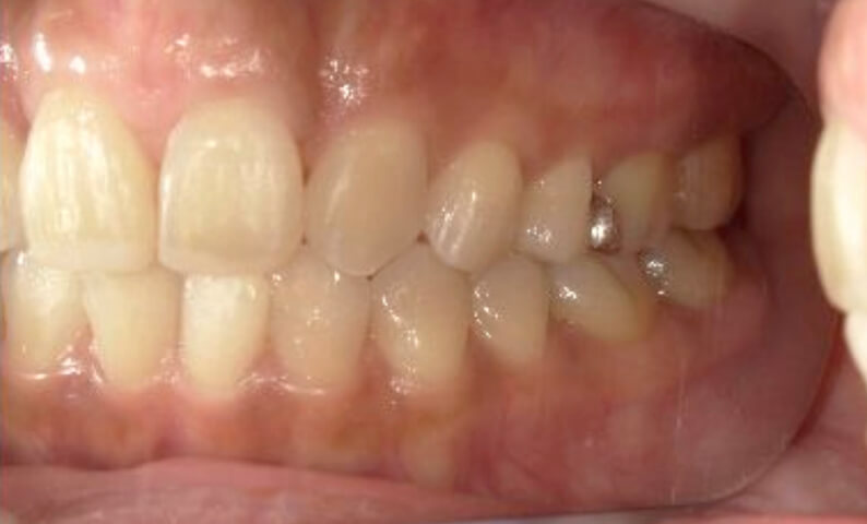 部分矯正 40代の症例写真