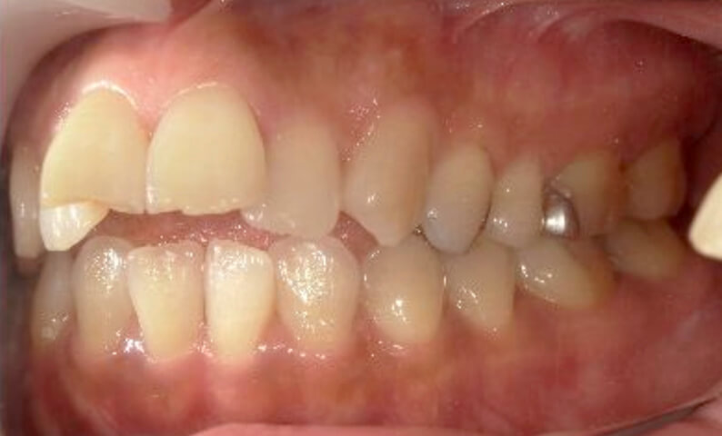 部分矯正 40代の症例写真