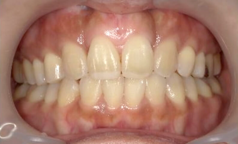 部分矯正 40代の症例写真