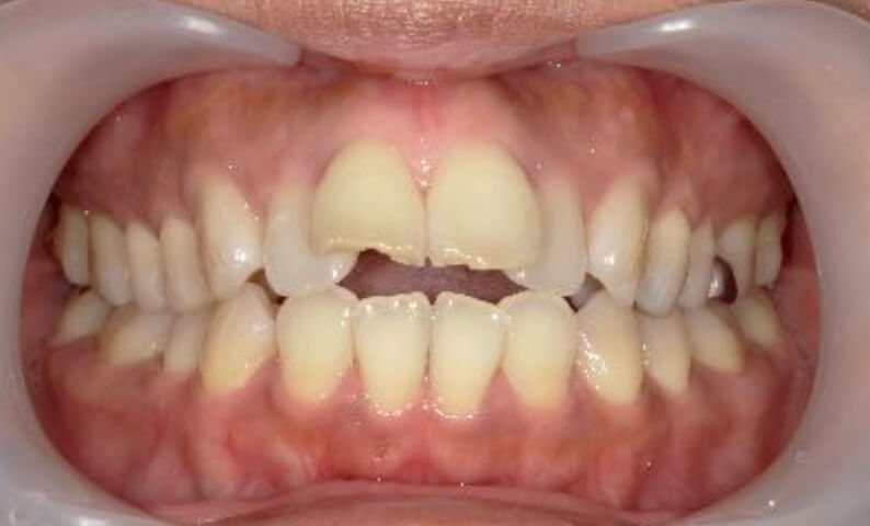 部分矯正 40代の症例写真