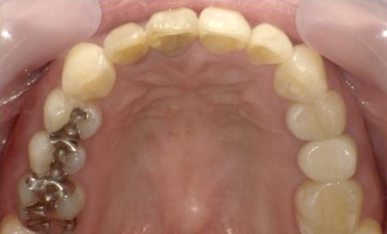 部分矯正 40代の症例写真