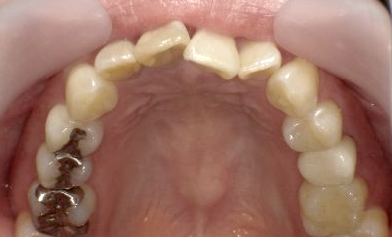 部分矯正 40代の症例写真