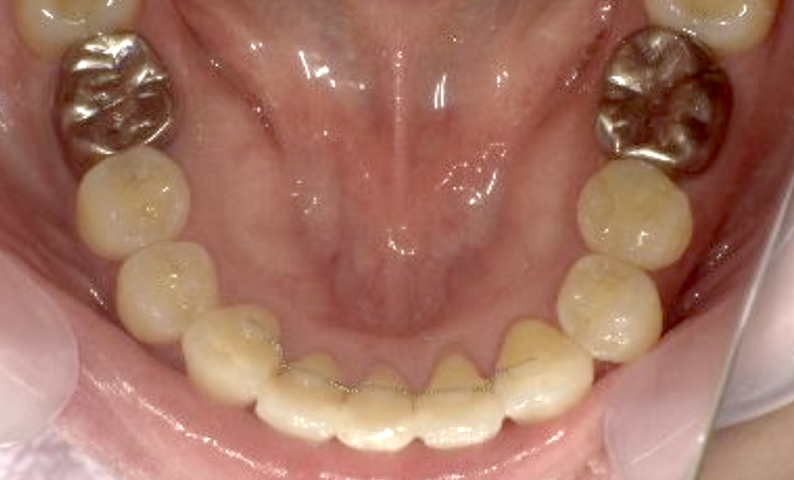 部分矯正 40代の症例写真