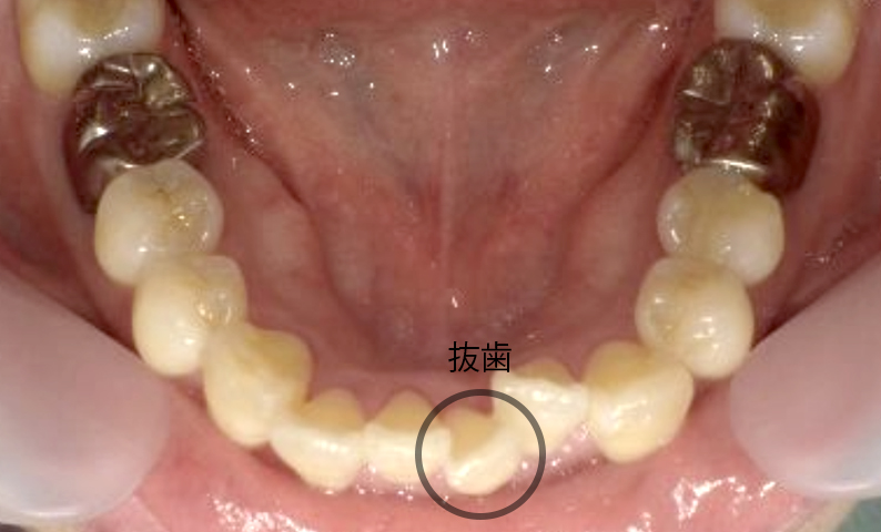部分矯正 40代の症例写真