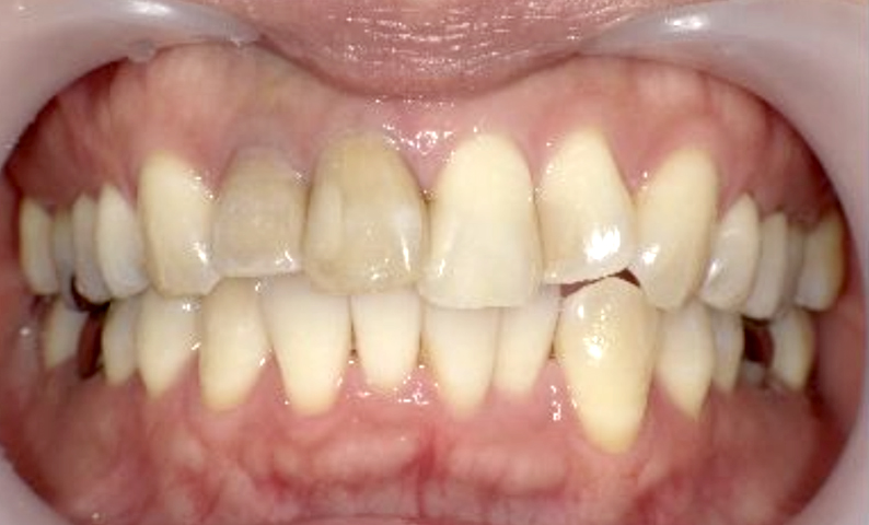 部分矯正 40代の症例写真