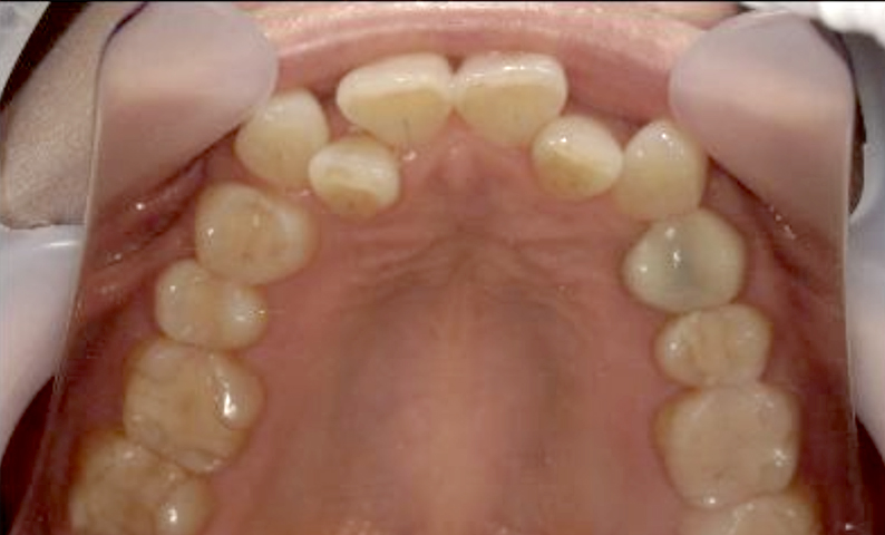 部分矯正 40代の症例写真