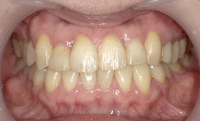 部分矯正 40代の症例写真