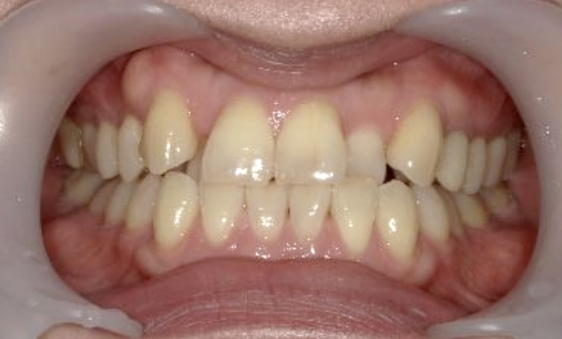 部分矯正 40代の症例写真