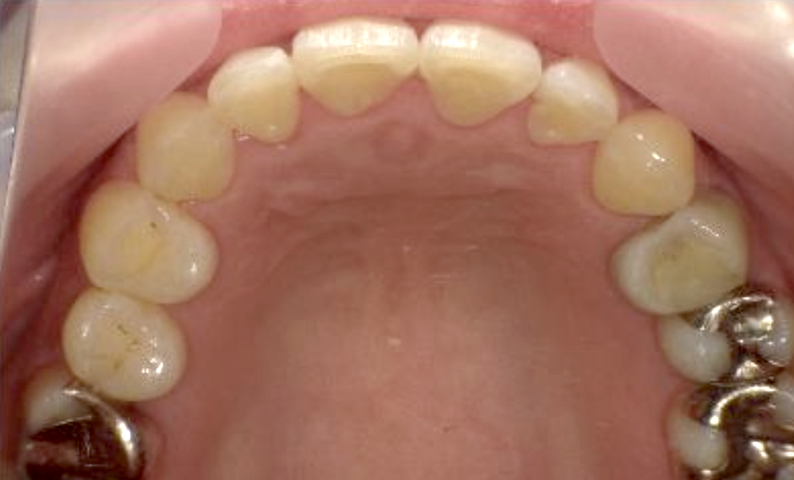 部分矯正 40代の症例写真