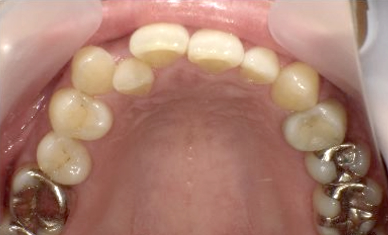 部分矯正 40代の症例写真