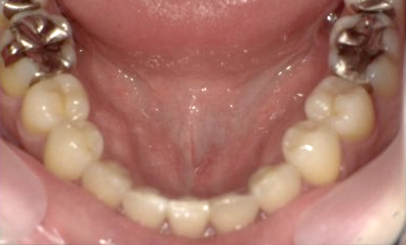 部分矯正 40代の症例写真