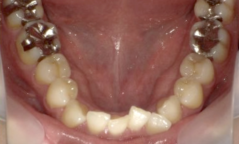 部分矯正 40代の症例写真