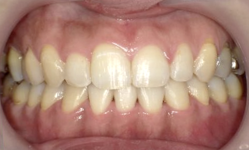 部分矯正 40代の症例写真