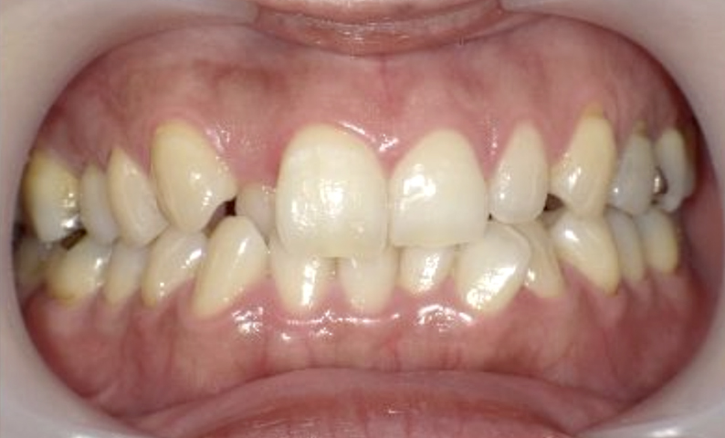 部分矯正 40代の症例写真