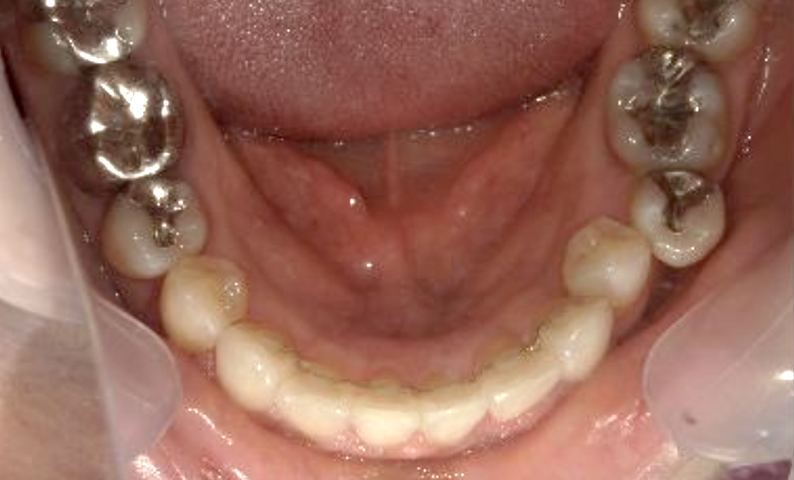 部分矯正 40代の症例写真