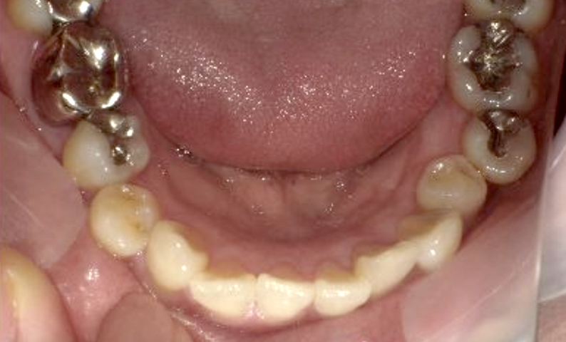 部分矯正 40代の症例写真