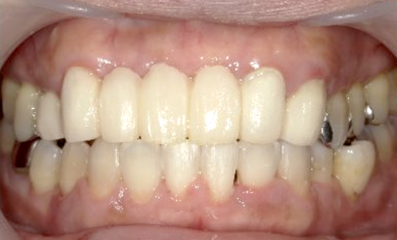 部分矯正 40代の症例写真