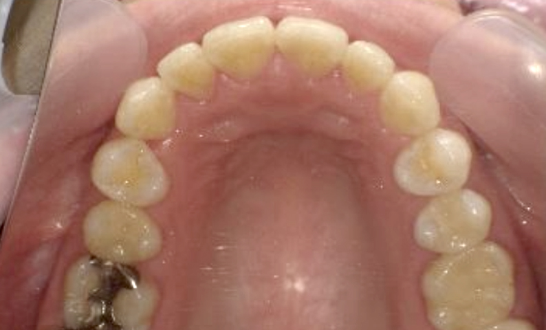 部分矯正 40代の症例写真