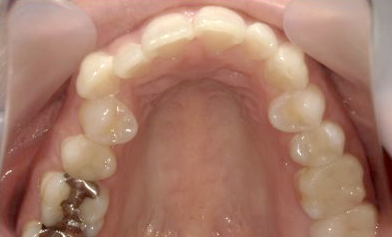 部分矯正 40代の症例写真