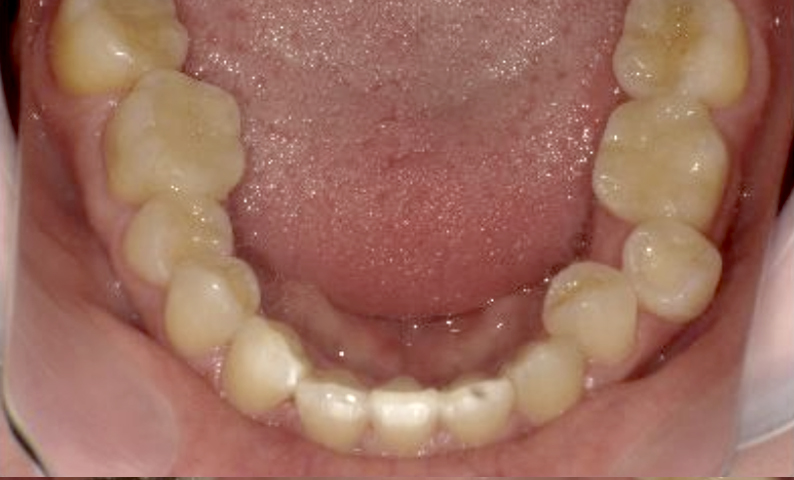 部分矯正 40代の症例写真