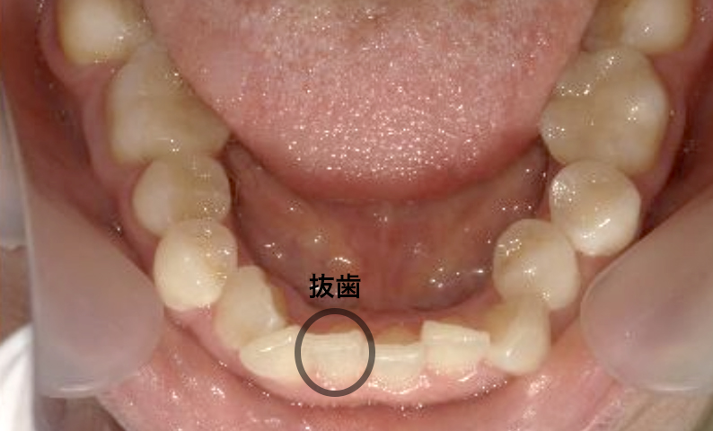 部分矯正 40代の症例写真