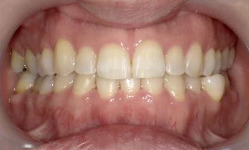 部分矯正 40代の症例写真