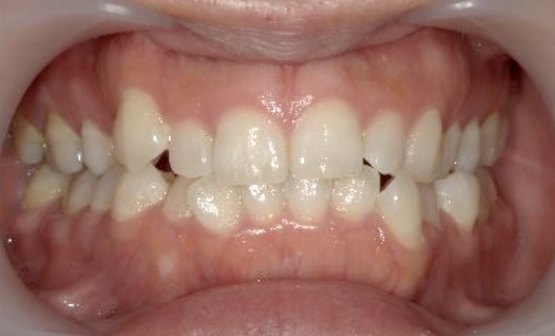 部分矯正 40代の症例写真