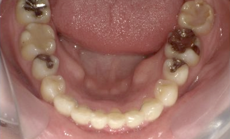 部分矯正 40代の症例写真