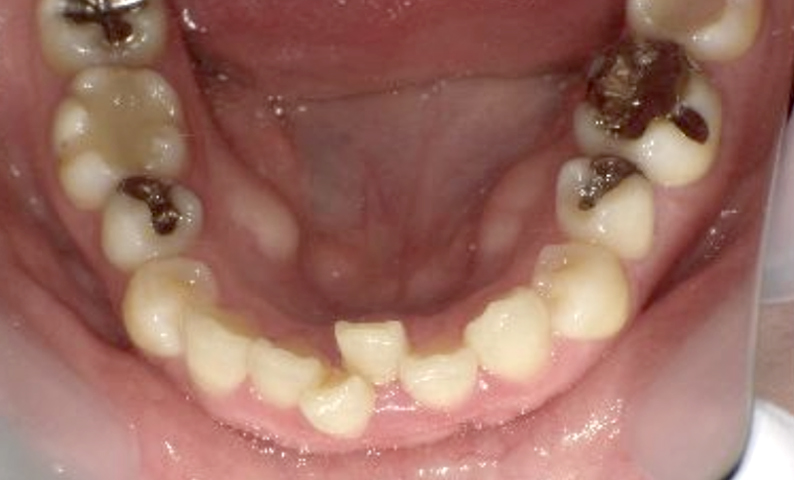 部分矯正 40代の症例写真