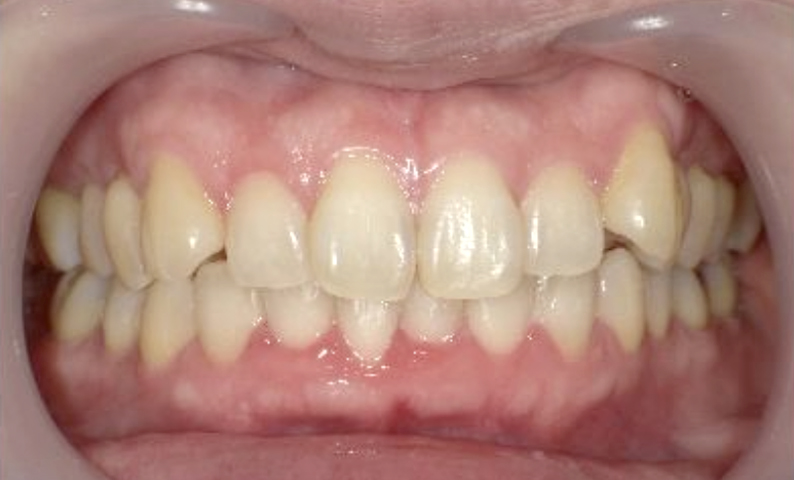 部分矯正 40代の症例写真