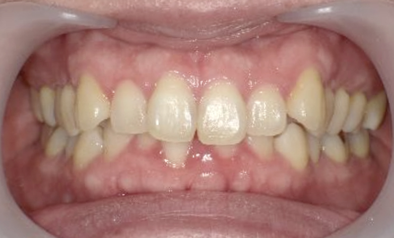 部分矯正 40代の症例写真