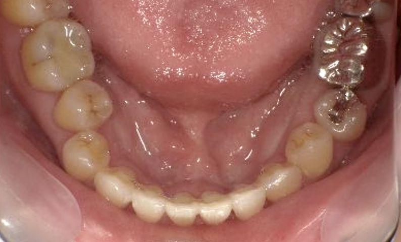 部分矯正 40代の症例写真