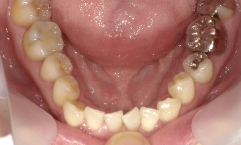 部分矯正 40代の症例写真