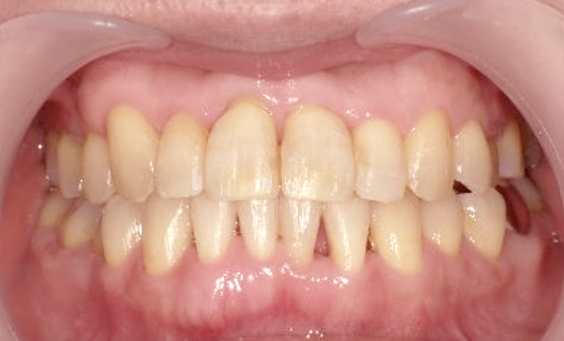 部分矯正 40代の症例写真