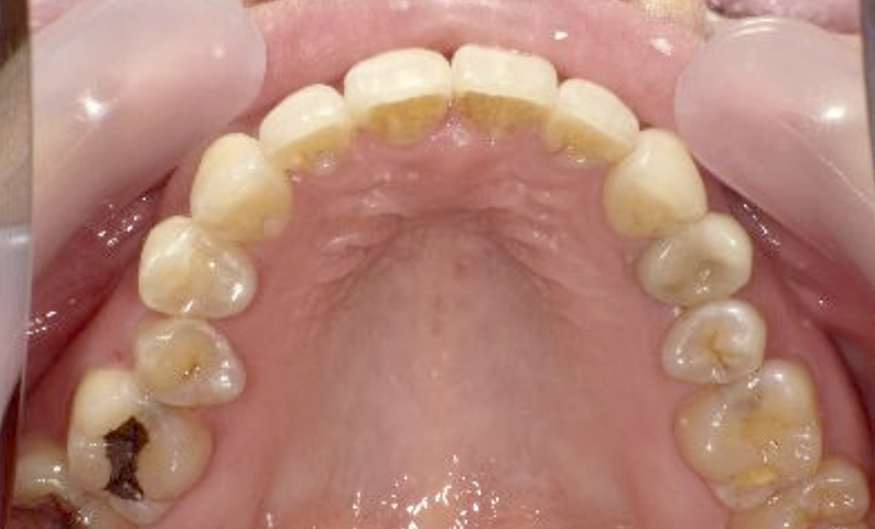 部分矯正 40代の症例写真