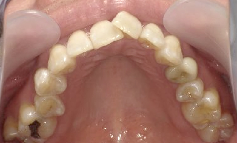 部分矯正 40代の症例写真