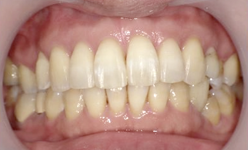 部分矯正 40代の症例写真