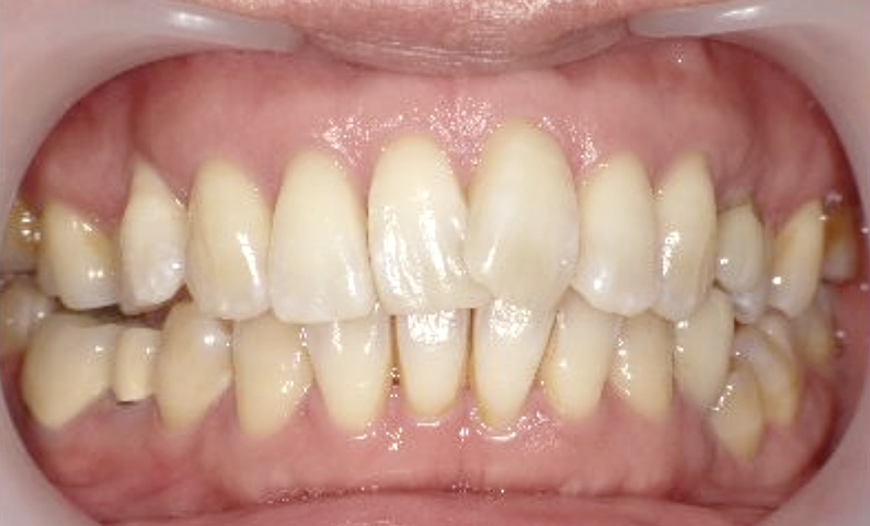 部分矯正 40代の症例写真