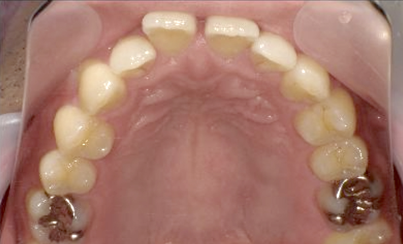 部分矯正 40代の症例写真