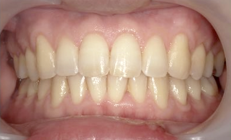 部分矯正 40代の症例写真