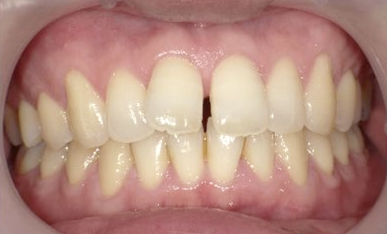 部分矯正 40代の症例写真