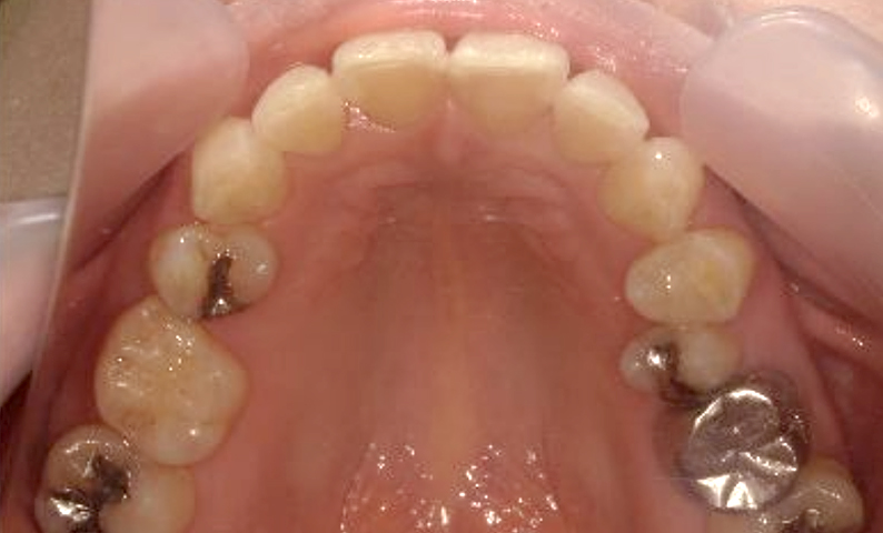 部分矯正 40代の症例写真