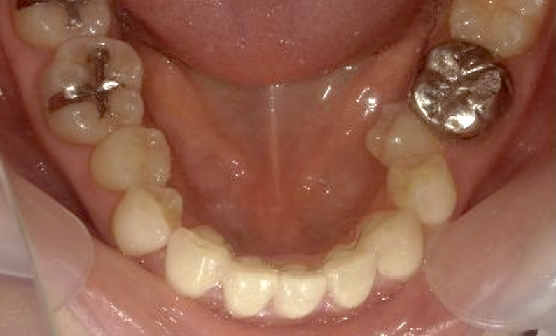 部分矯正 40代の症例写真