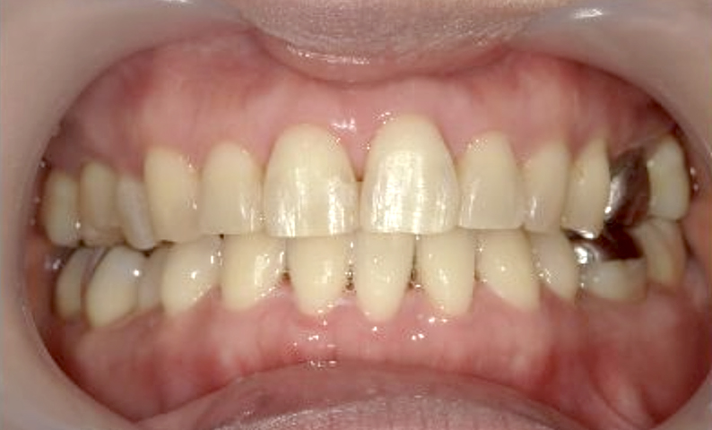 部分矯正 40代の症例写真